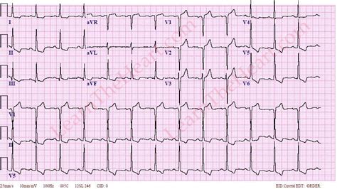 lvh strain pattern ecg|mylvhn login patient portal.